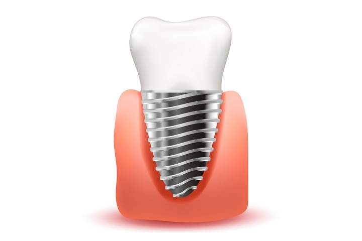 7 Benefits of Dental Implants