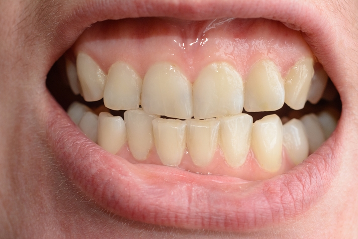 canines teeth in human