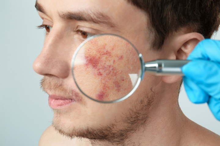 The Beginner’s Guide to Dark Spots vs Acne Scars