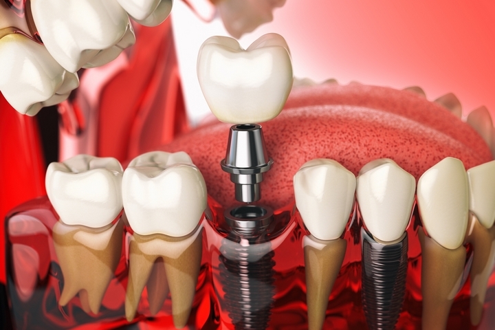 4 Common Complaints About Dentures